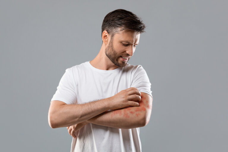 Dermatitis,,Eczema,,Allergy,,Psoriasis,Concept.,Annoyed,Middle-aged,Man,In,White